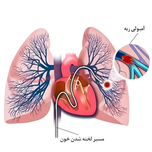 خطر آمبولی ریه از عوارض جانبی داروی لوسوترومبوپگ